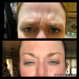 Botulax 200 Units photo review