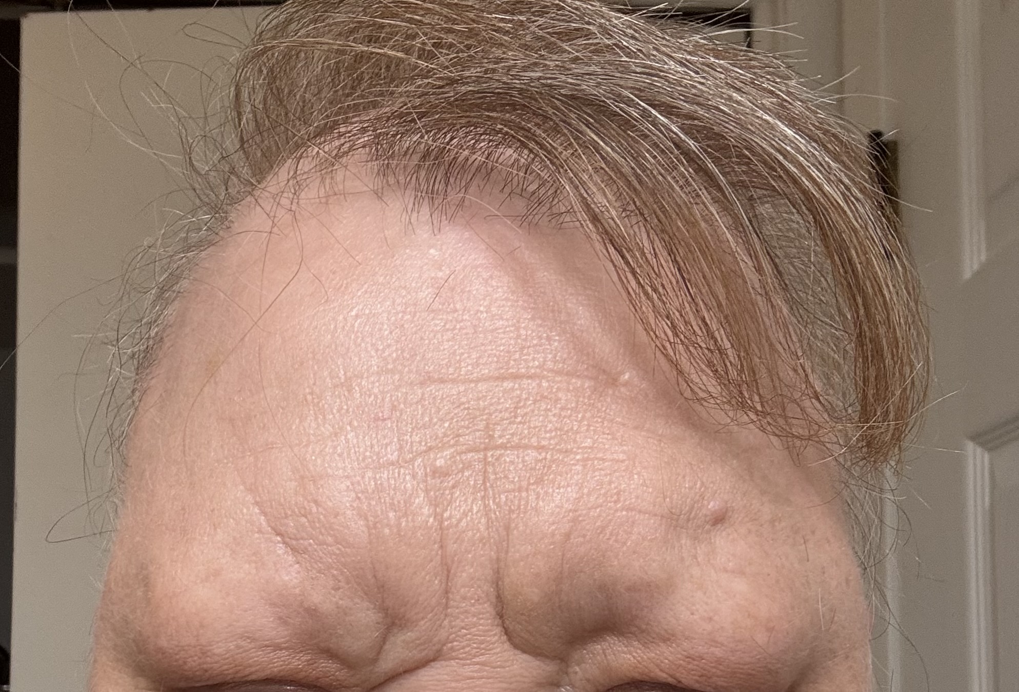 Innotox 100 Units photo review