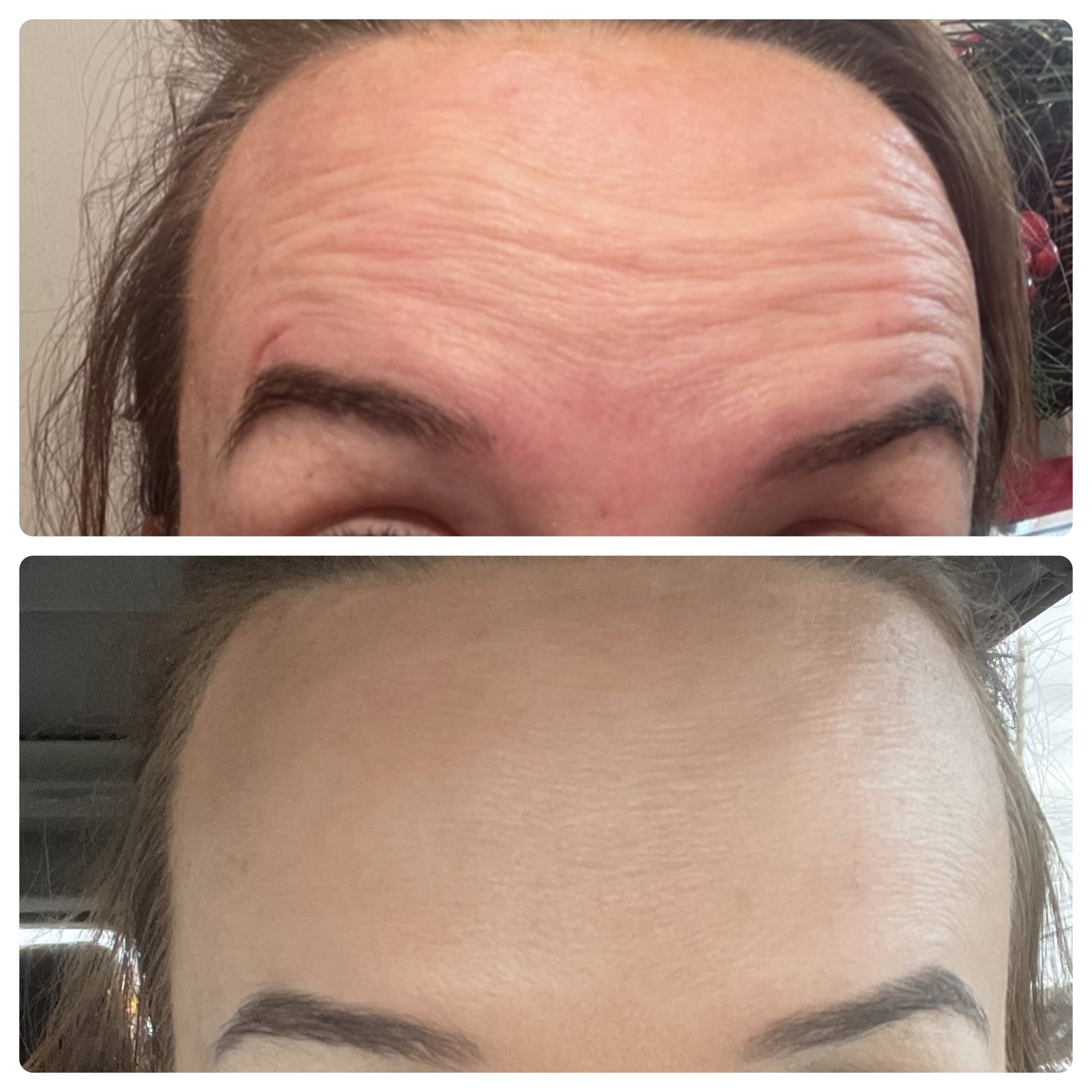 Botulax 200 Units photo review