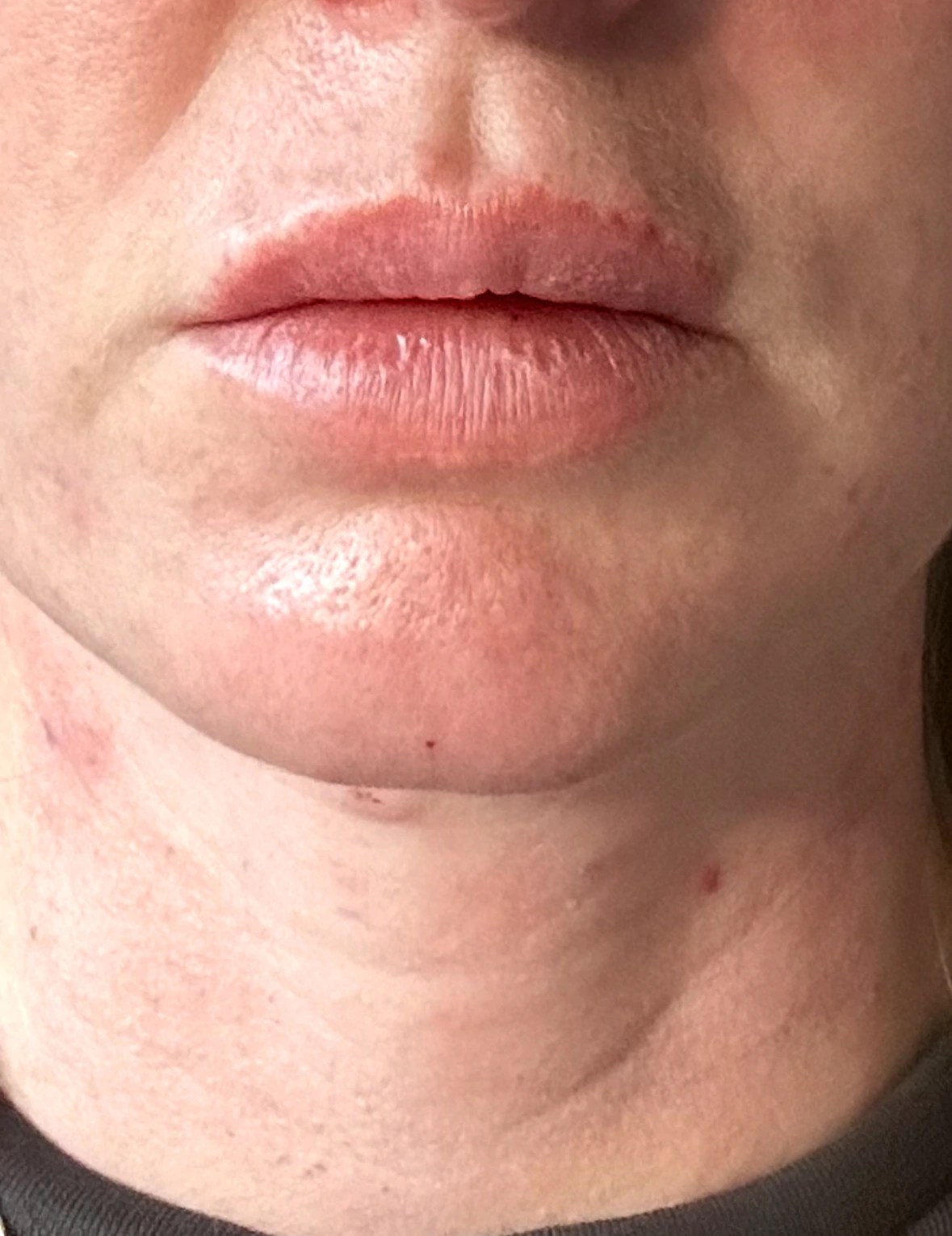 Innotox 100 Units photo review