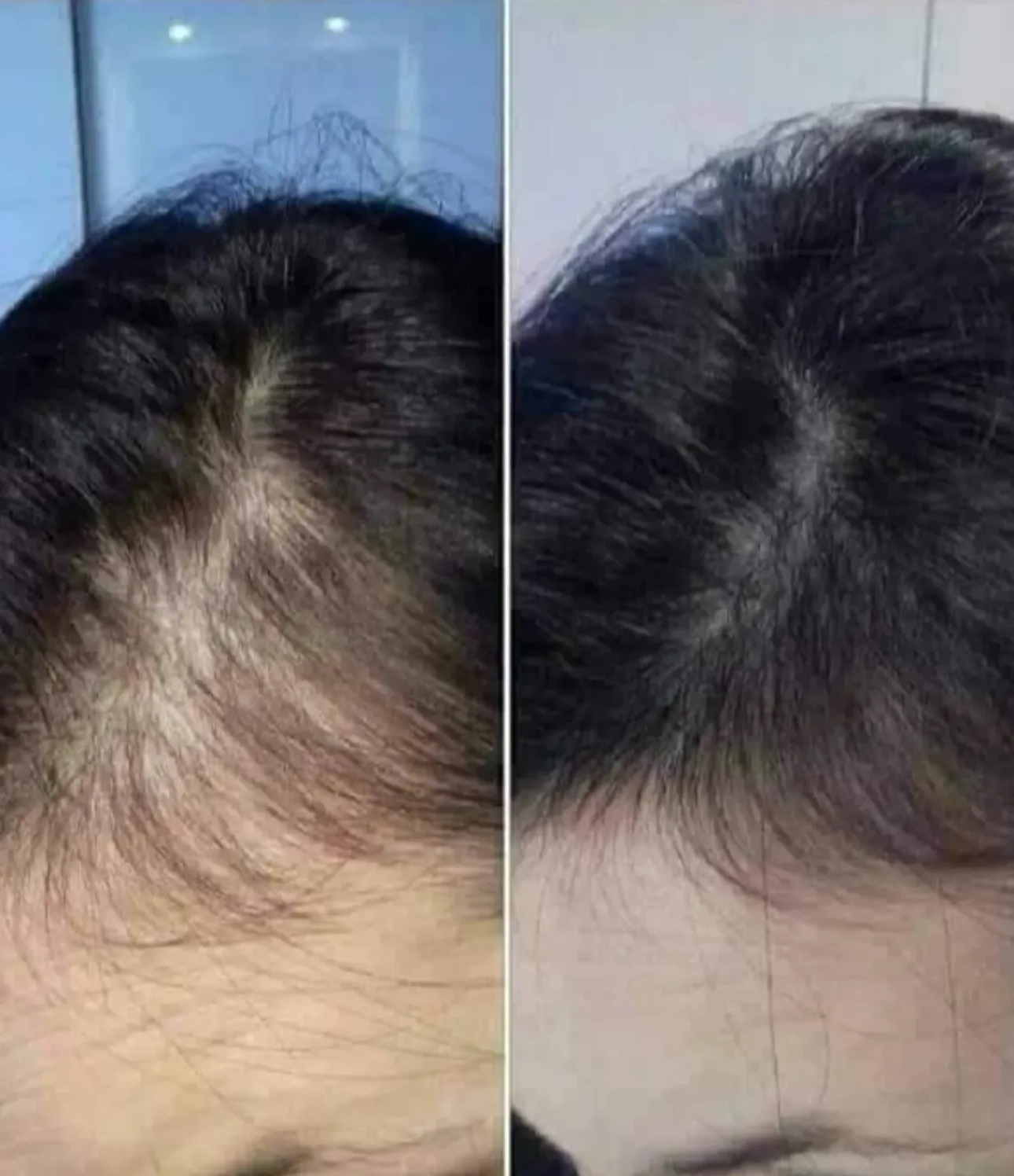 Hanheal Exosome Hair Filler photo review