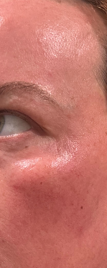 Metox 100 Units photo review