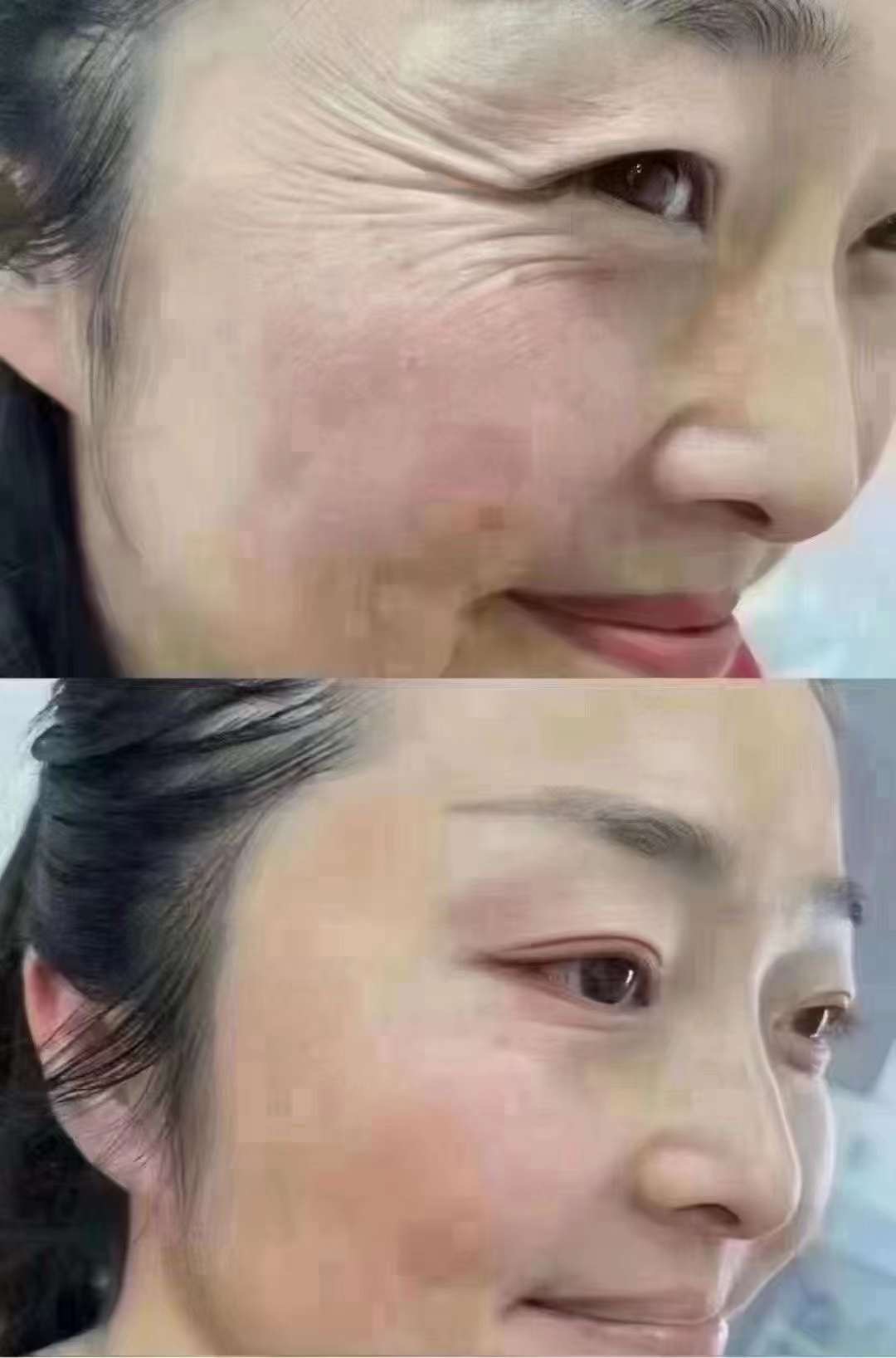 Metox 100 Units photo review