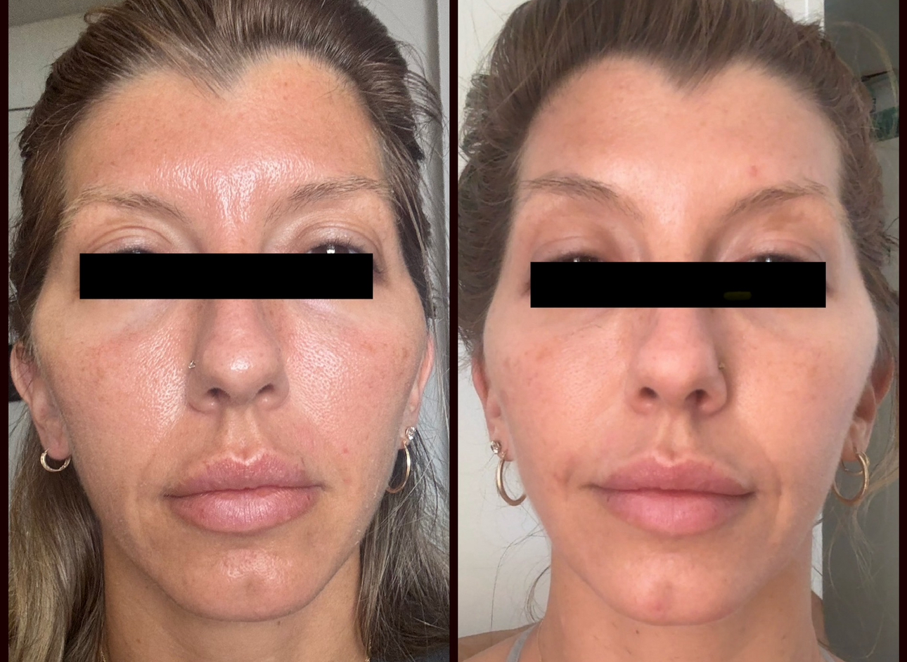 Metox 100 Units photo review