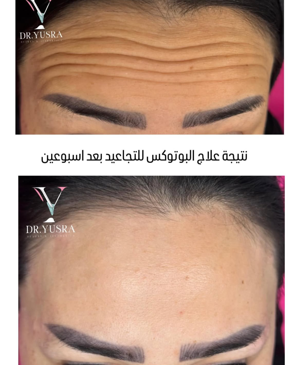 Bienox 100 units photo review