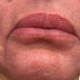 Zerotox 100 Units photo review