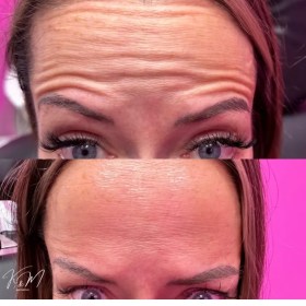 Botulax 300 Units photo review