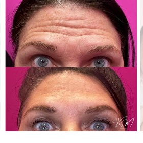 Botulax 300 Units photo review