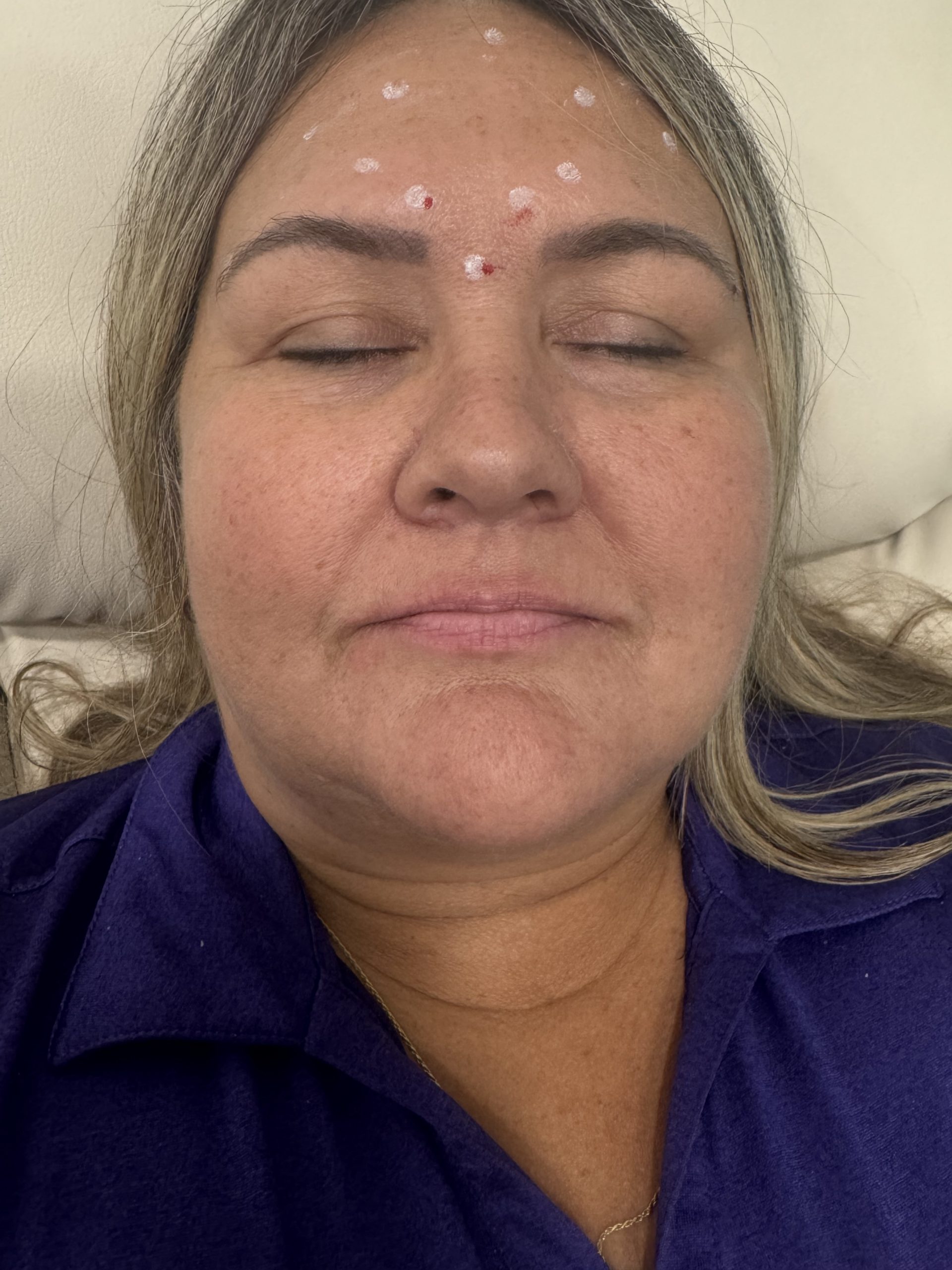 Metox 200 Units photo review