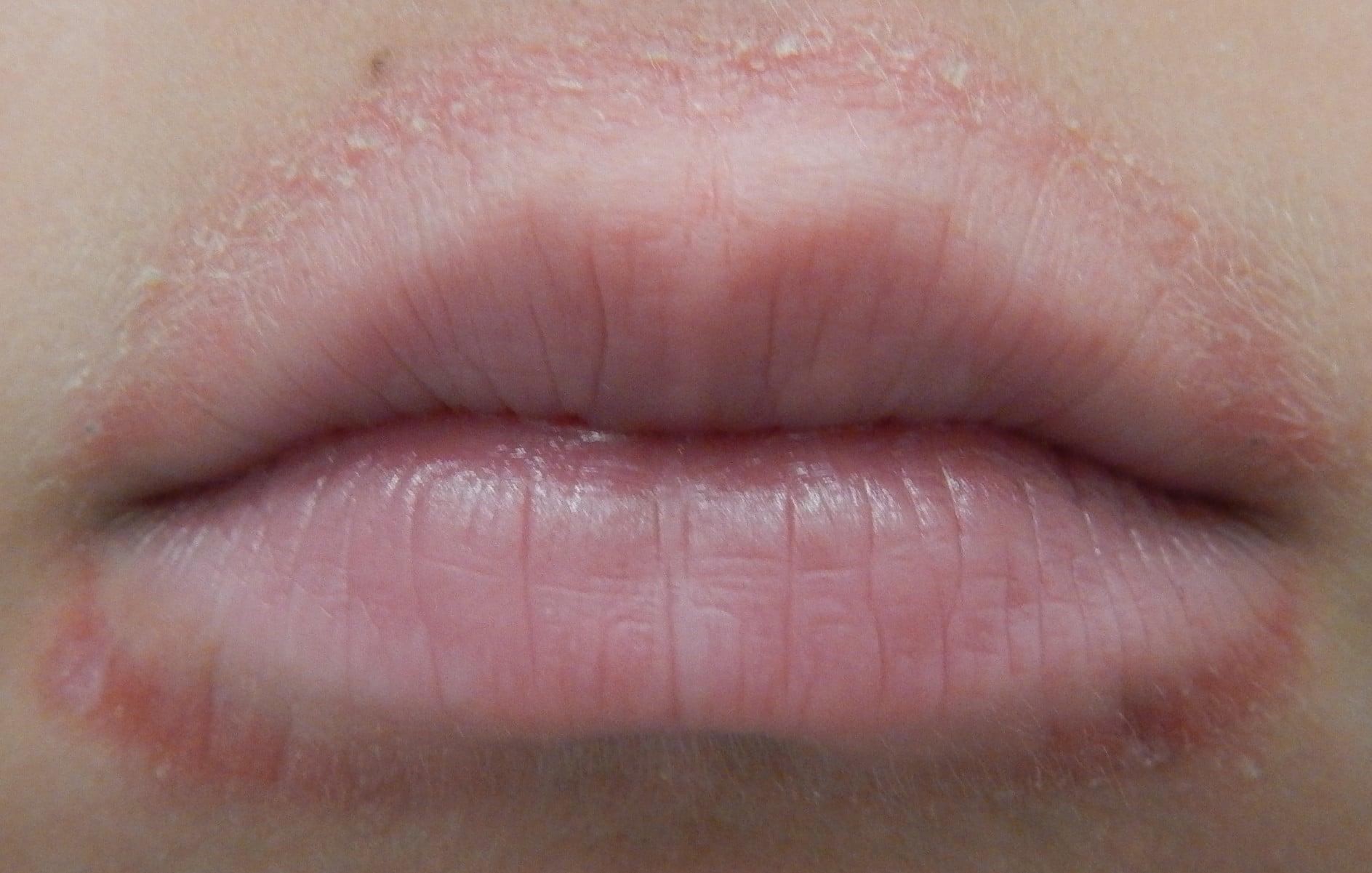 Lesen sie hier, was sie dagegen tun können! Mundrose Periorale Dermatitis Ursachen Therapie Derma Plus