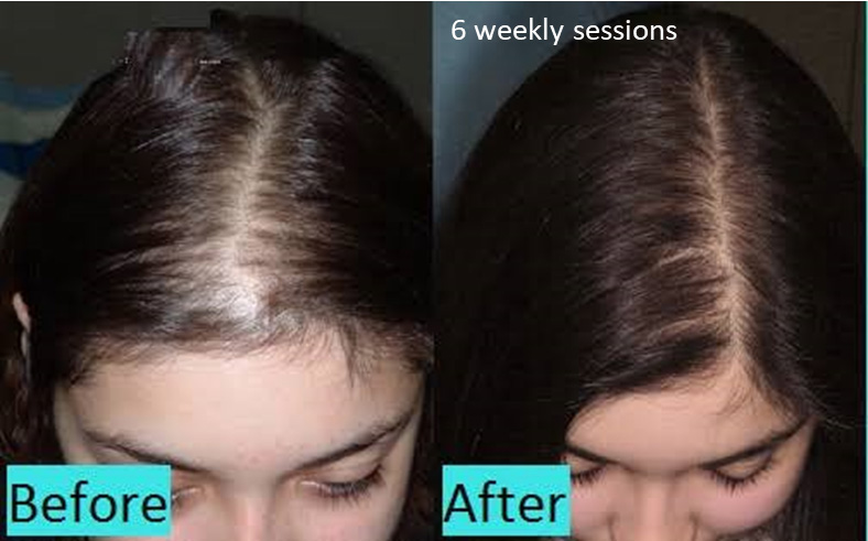 Key points clobetasol propionate, the active ingredient in clobex spray 0.05%, has been shown to be effective for. Hair Scalp Treatment Dermaroller Micro Needling Collagen Induction Therapy