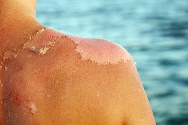 sunburn