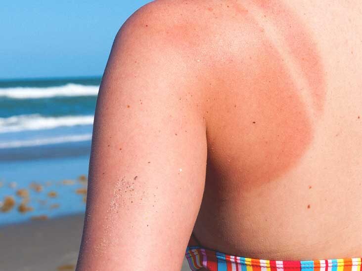 sunburn