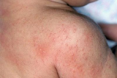 How To Get Rid Of Rashes