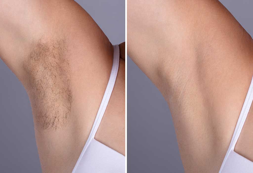 Different Ways To Remove Underarm Hair