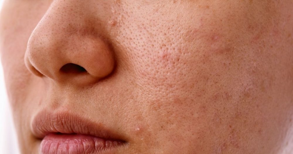 How To Treat Sebaceous Filament?