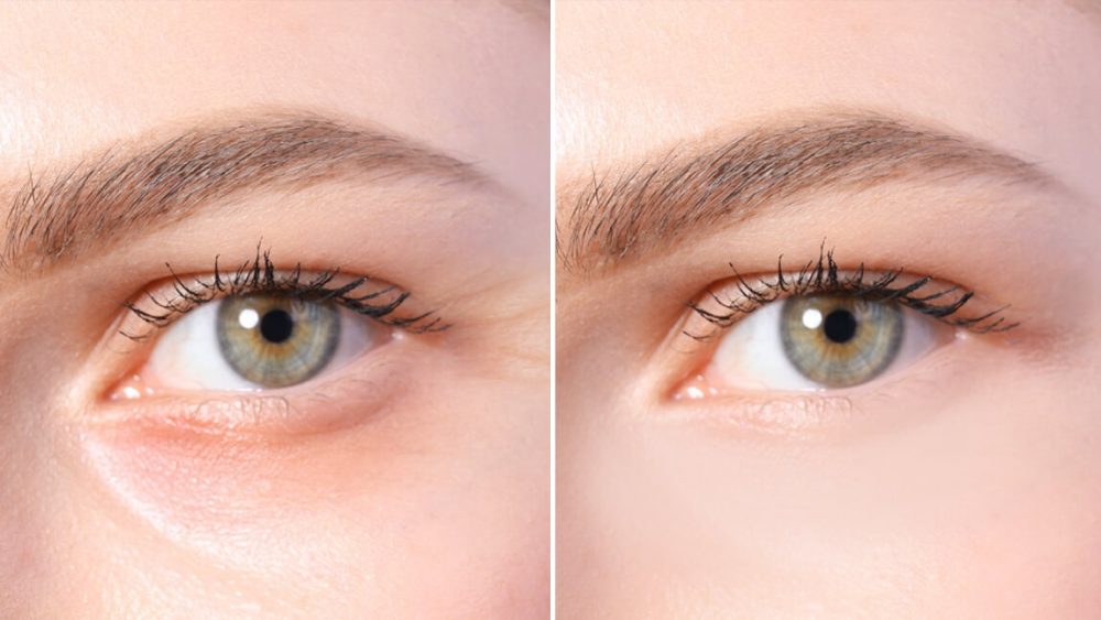 How To Prevent Undereye Wrinkle