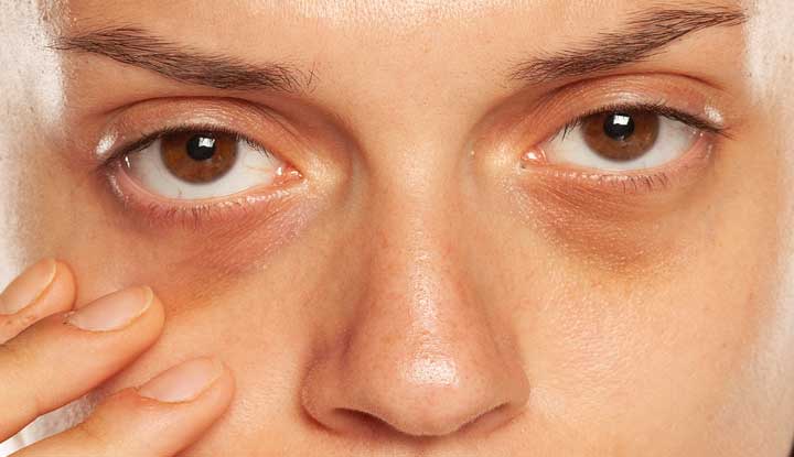 How To Get Rid Of Dark Under Eye Circle Quick