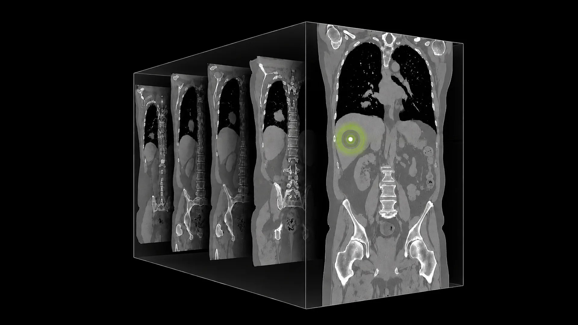 Introducing NV-Reason-CT Open 3D CT VLM for Radiologist Chain-of-Thought Reasoning | NVIDIA Technical Blog