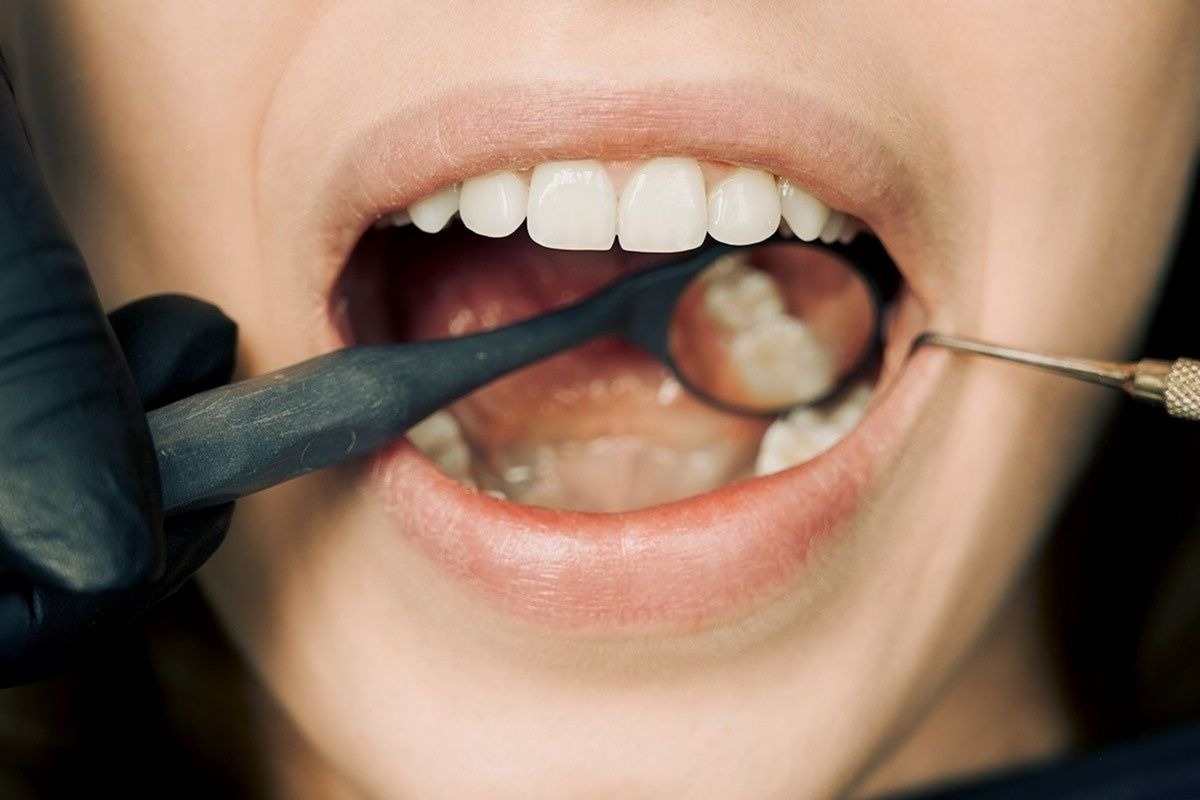 How Teeth Whitening Compares to Veneers for Stained Teeth
