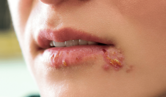 This can help make your sore less red and crusty and help it heal . Difference Between Cold Sore And Fever Blister Differbetween