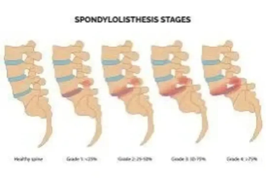 Comprehensive Guide to Spondylolisthesis: Causes, Symptoms, Treatments, and Prevention Strategies for Improved Spine Health