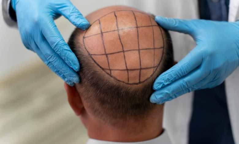 Unveiling the Art and Science of Turkey Hair Transplants: A Comprehensive Guide to Restoring Hair Health and Confidence