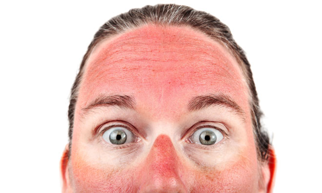 The shocking facts about vitamin d. Vitamin D may improve sunburn, says new clinical trial