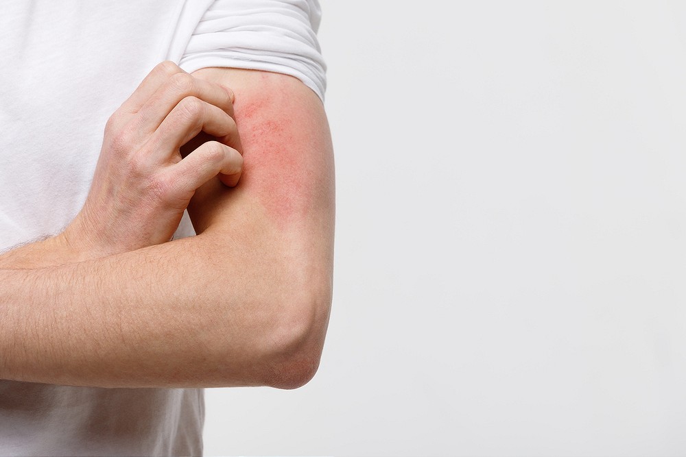 Worst itch in atopic dermatitis DocMode Health Technologies Limited