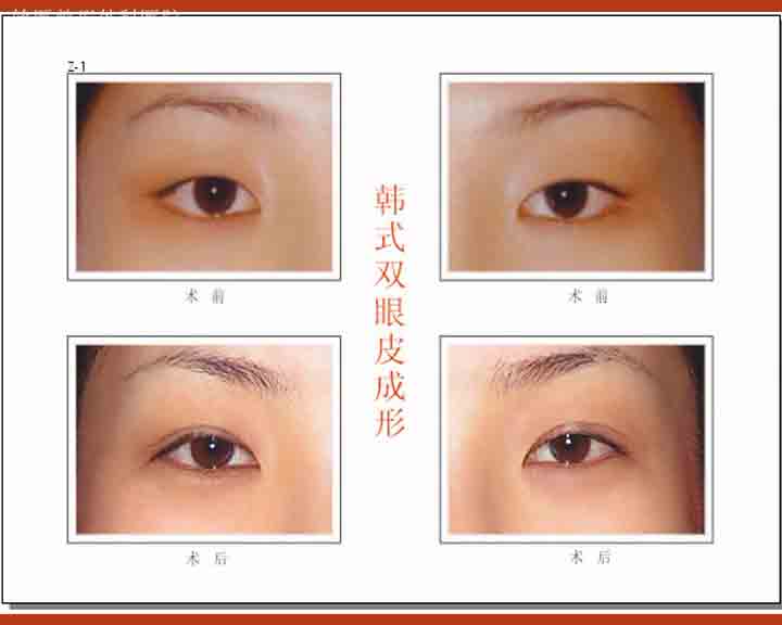 眼皮抽脂dcard 必利勁能懷孕 Attention Gkgnae