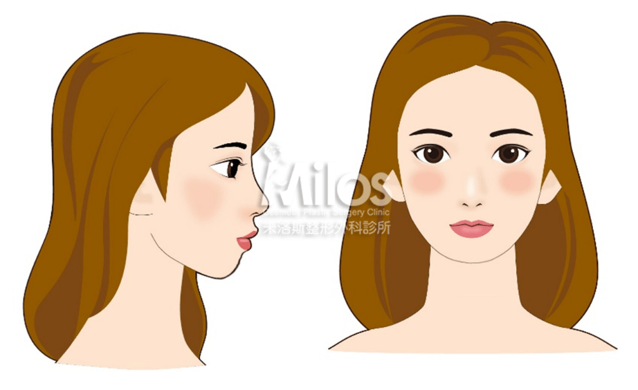 下巴後縮或偏短的患者,都可以透過墊下巴手術來改善臉型。