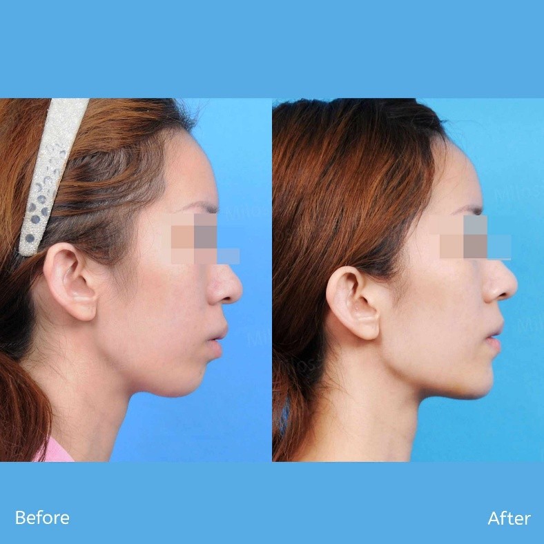 精準微調下巴長度與角度,改善側臉比例,讓輪廓線條更立體自然。