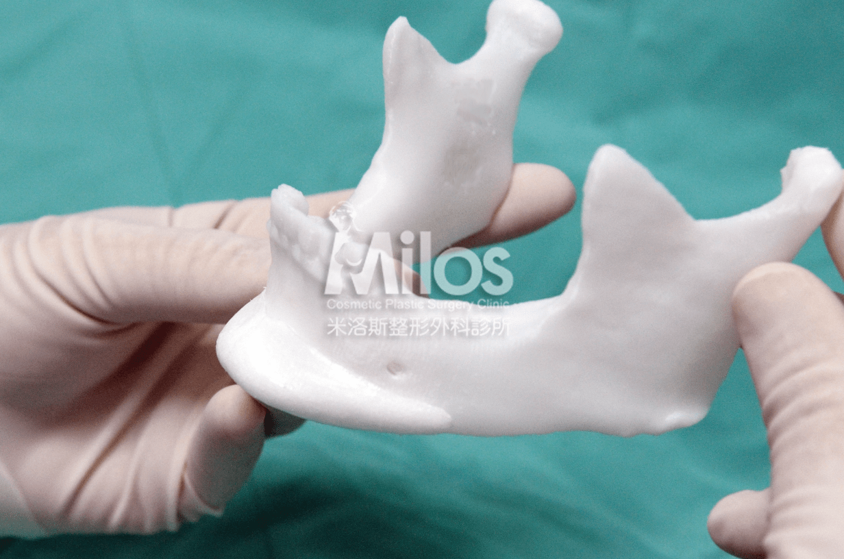 透過術前客製化植體,能使植體與骨骼完美貼合,不易位移。