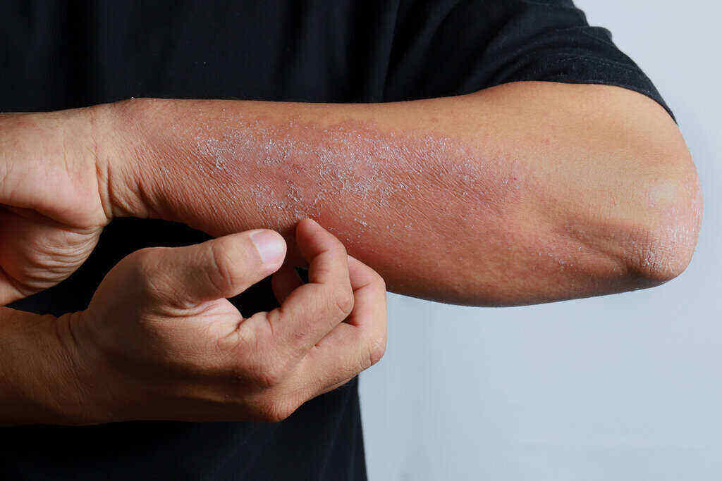 Cara mengobati koreng di kepala akibat dermatitis herpetiformis. Macam Macam Dermatitis Yang Harus Diwaspadai Doktersehat