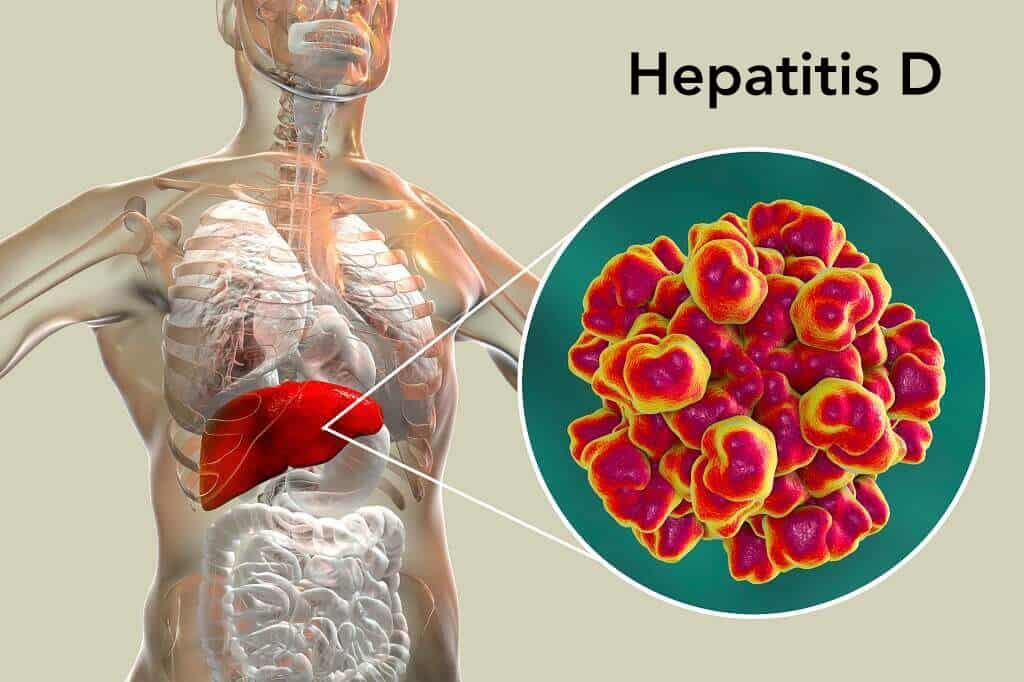 Hepatitis D Penyebab Gejala Penularan Obat Dll