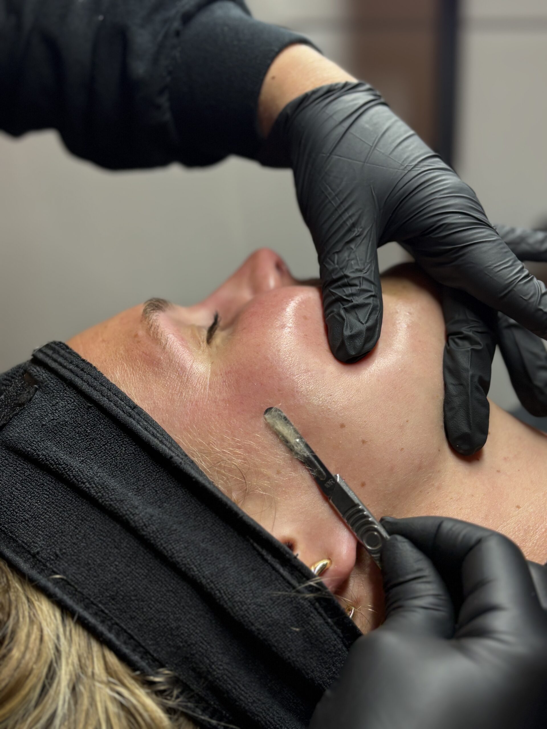 dermaplaning