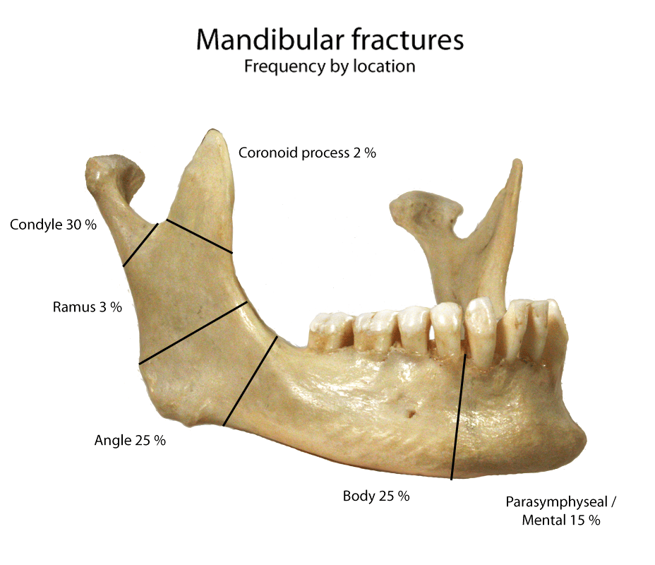 Mandible X Rays