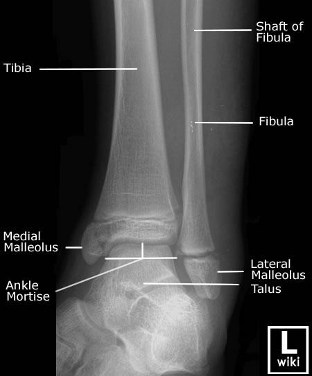 Ankle Rx Ankle x-rays - Don't Forget the Bubbles