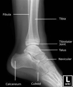 Ankle Rx Ankle x-rays - Don't Forget the Bubbles