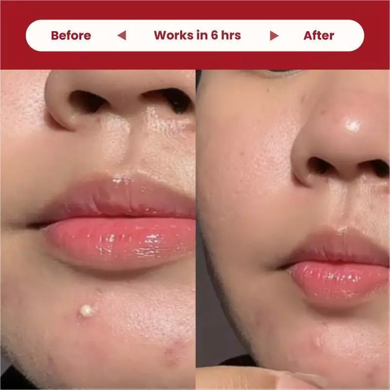 ClearUp Microdarts for Acne | Microneedle Patches for Blind Pimples | Pure Hydrocolloid Skincare
