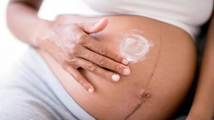 Keloid Muncul Pasca Melahirkan Caesar Coba 5 Cara Alami Ini Moms