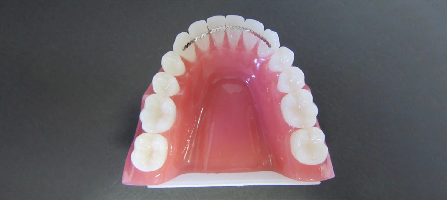 Fixed Retainers