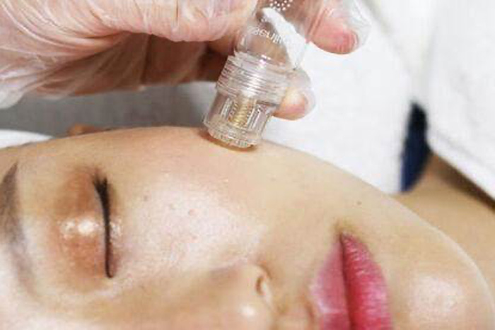 microinfusion
