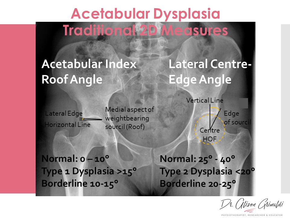 Acetabular dysplasia