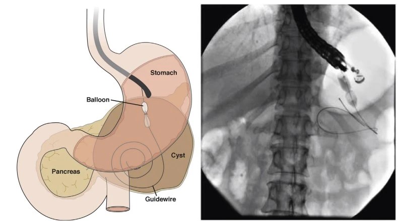 Navigating pancreatic pseudocysts: the role of endoscopic ultrasound