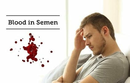 Hematospermia: sperma berarah, pantangan, dan apakah berbahaya