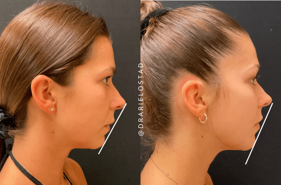 Your Guide to NonSurgical Chin Augmentation Dr. Ariel Ostad, MD