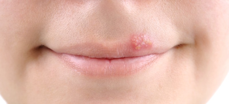 We may receive a portion of. Cold Sores How To Get Rid Of Cold Sores Naturally Dr Axe