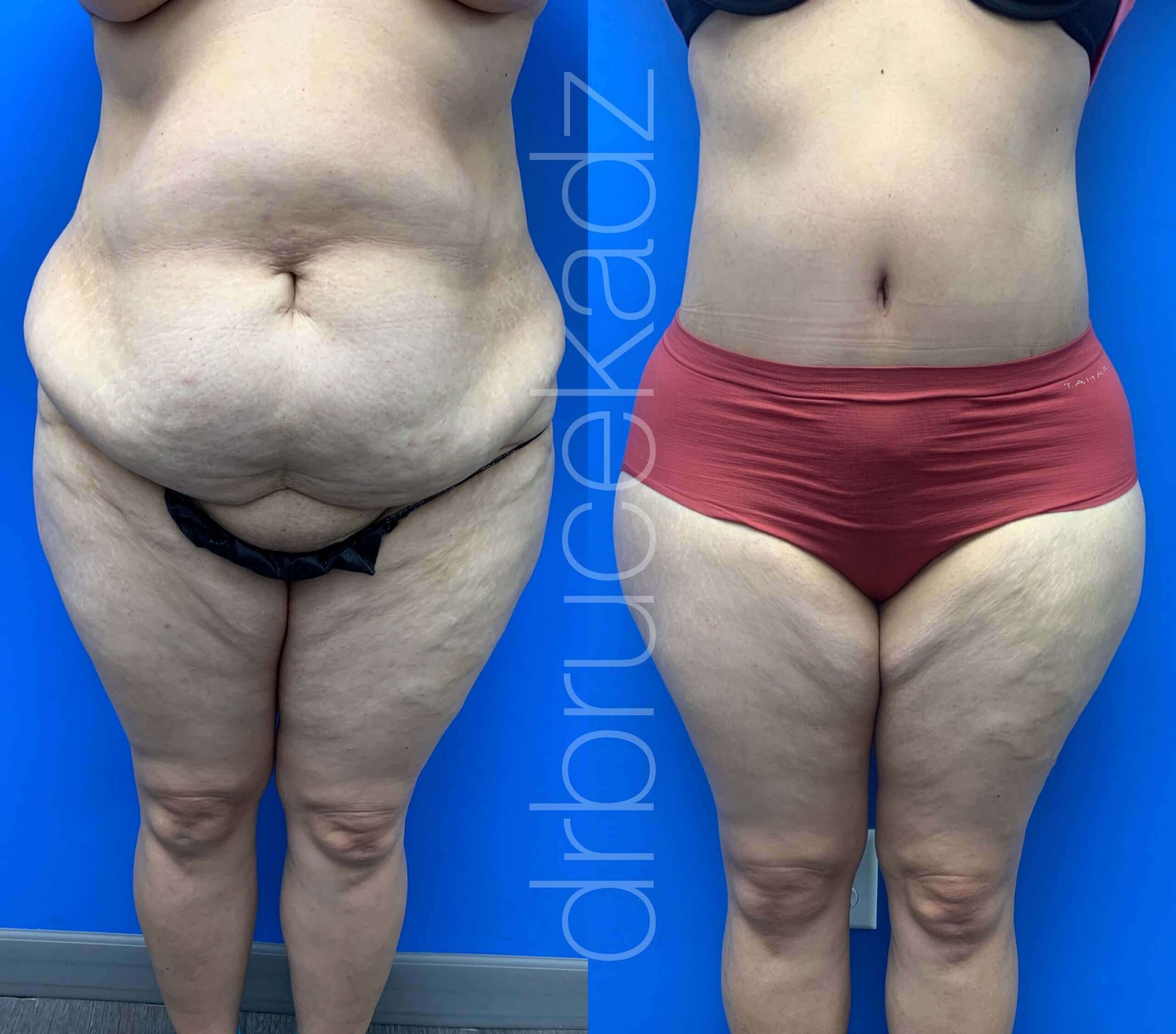 How much weight do you lose from a tummy tuck?