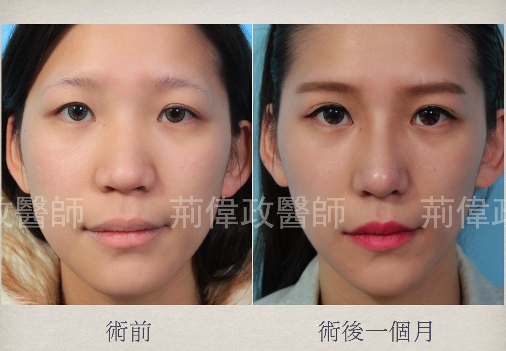 敲 鼻骨讓鼻梁變窄 荊偉政整形外科醫師 台北璞美整形外科醫美診所院長 削骨拉皮國際級講師 威塑抽脂一二代雙認證醫師